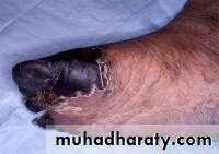 Antiphospholipid Syndrome