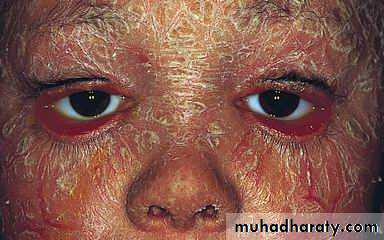 Antiphospholipid Syndrome