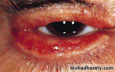 Antiphospholipid Syndrome