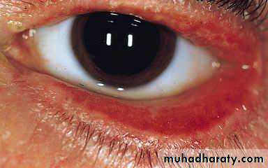 Antiphospholipid Syndrome
