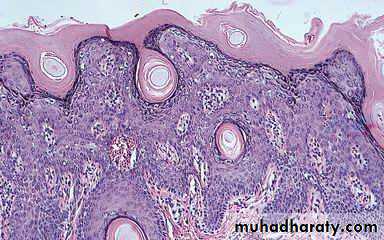 Antiphospholipid Syndrome