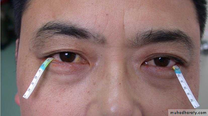Antiphospholipid Syndrome
