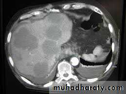 Liver and Biliary Diseases