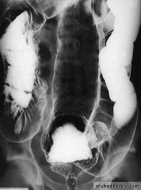 Small and Large Bowel