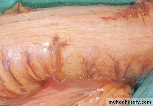Small and Large Bowel