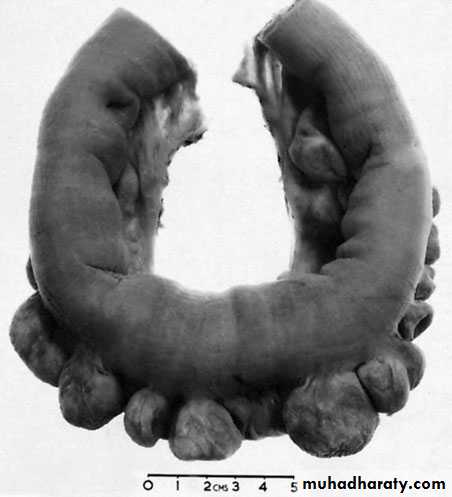 Small and Large Bowel