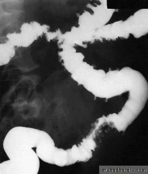 Small and Large Bowel