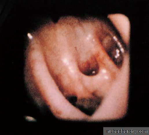 Small and Large Bowel
