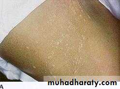 Liver and Biliary Diseases
