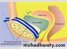 Urinary Incontinence