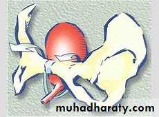 Urinary Incontinence