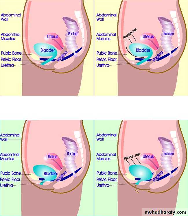 Urinary Incontinence
