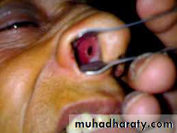 Epistaxis