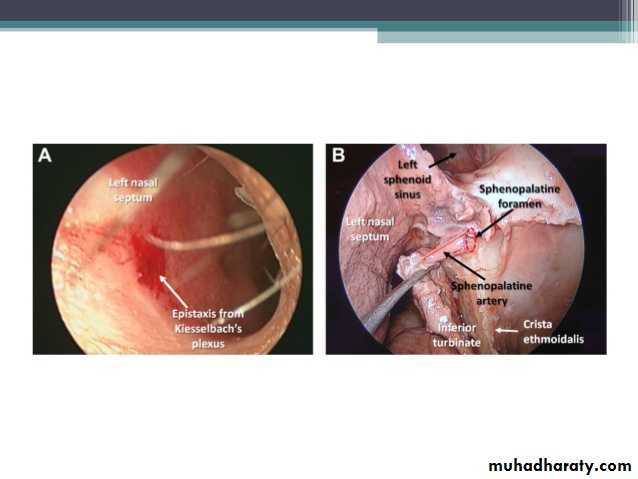 Epistaxis