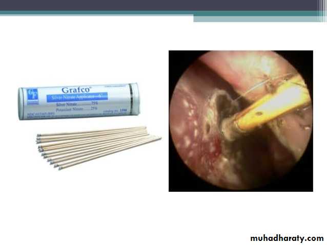 Epistaxis