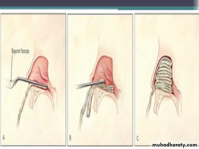 Epistaxis