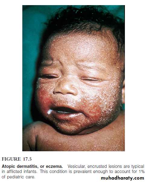 Disorders in Immunity