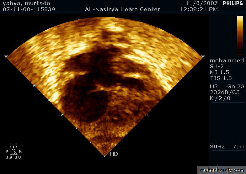 CHD