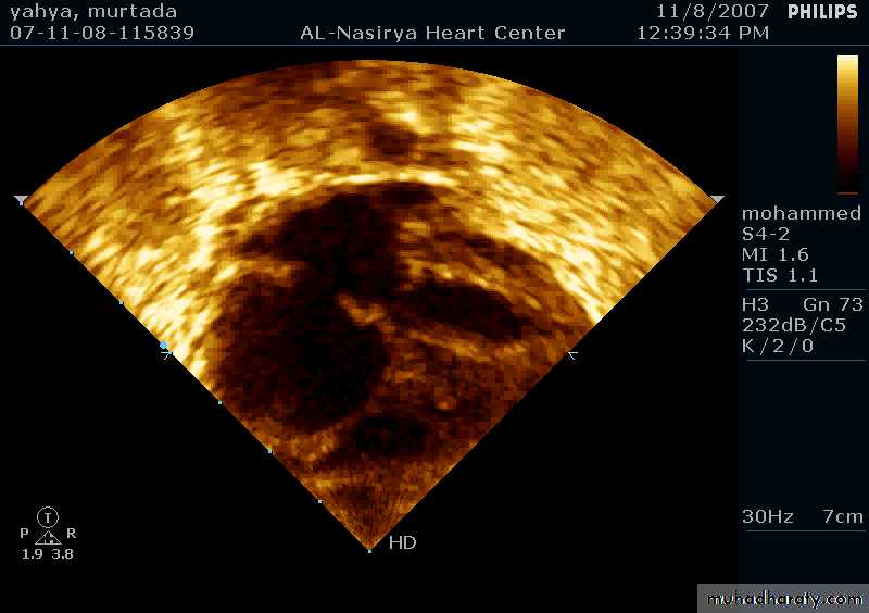 CHD