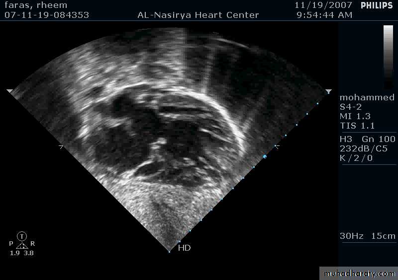 CHD