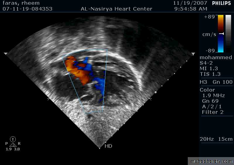 CHD