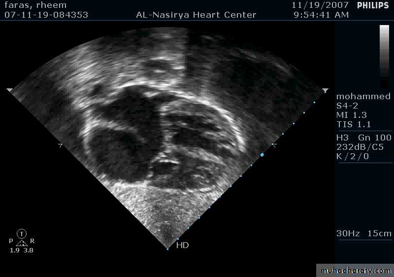 CHD