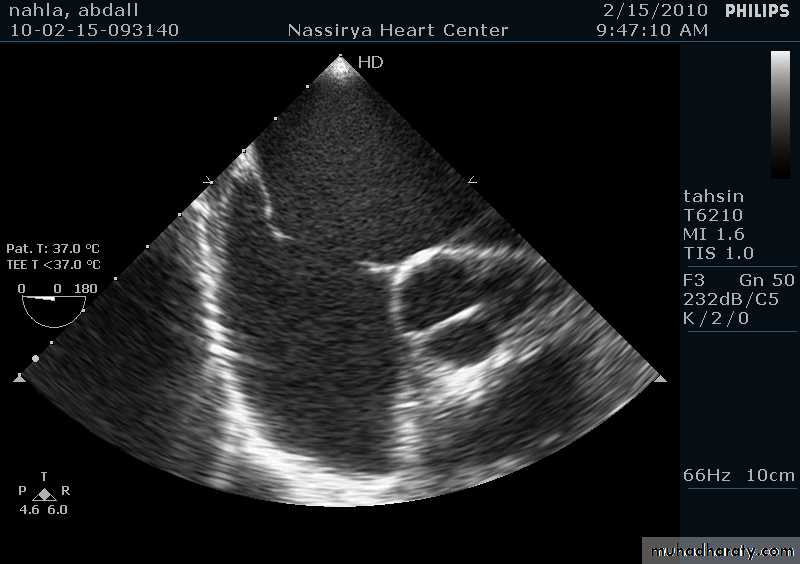 CHD