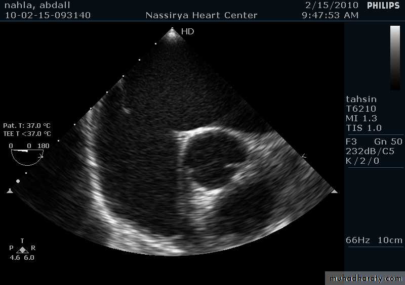 CHD