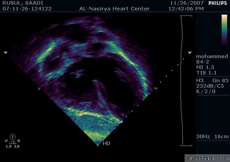 CHD