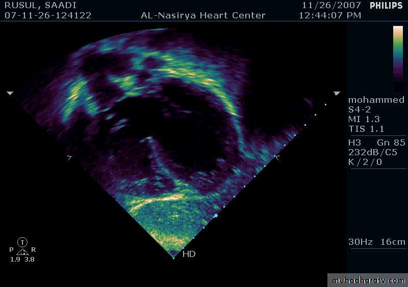 CHD