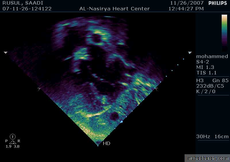 CHD