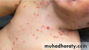Pertussis