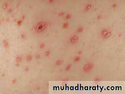 Pertussis