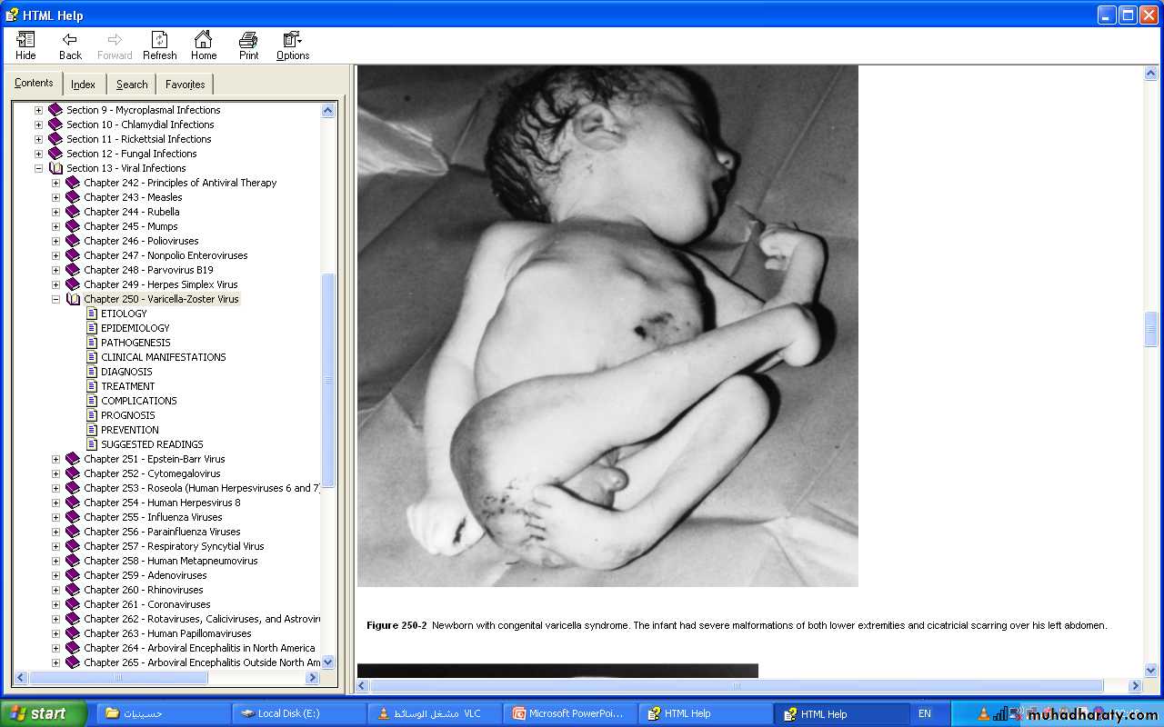 Pertussis