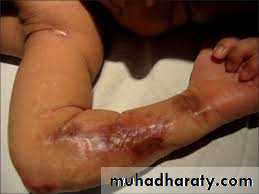 Pertussis