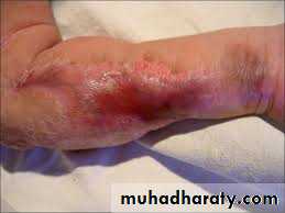 Pertussis
