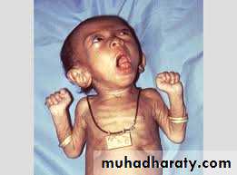 Pertussis