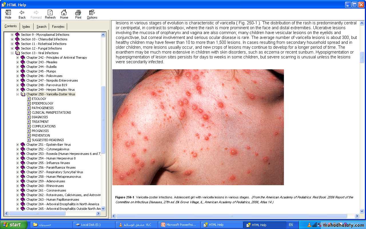 Pertussis
