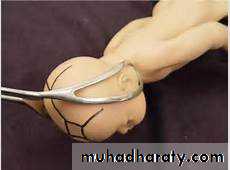 Instrumental delivery