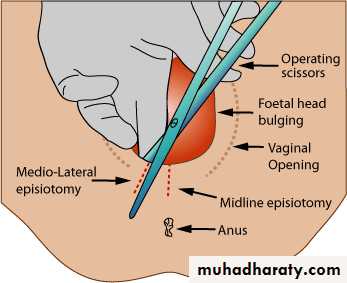 Instrumental delivery