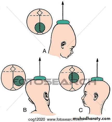 Instrumental delivery