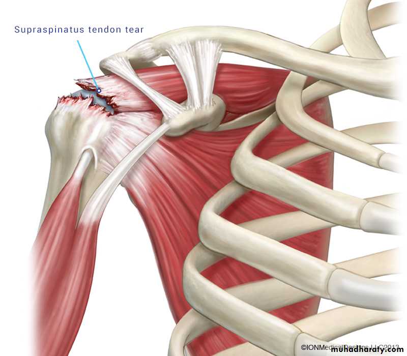 Shoulder disorders