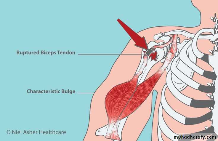 Shoulder disorders