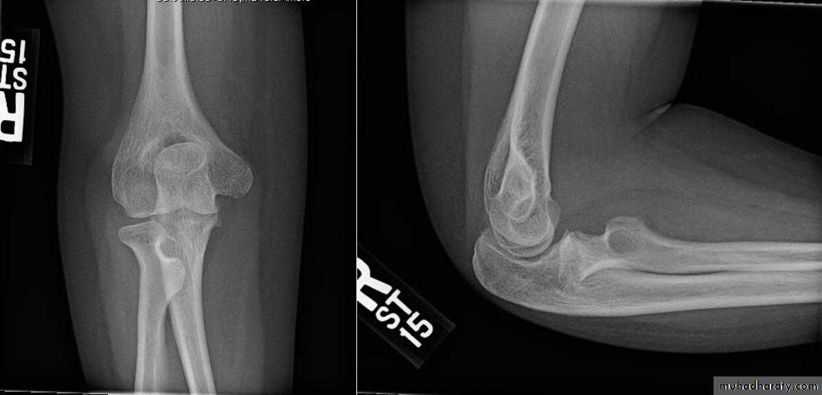 Elbow disorders