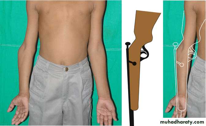 Elbow disorders
