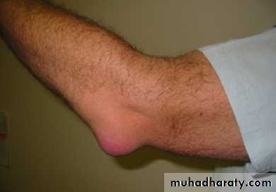 Elbow disorders