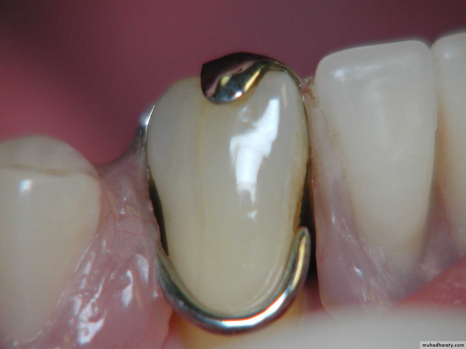 mouth preparation
