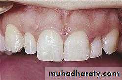 Development tooth disorders
