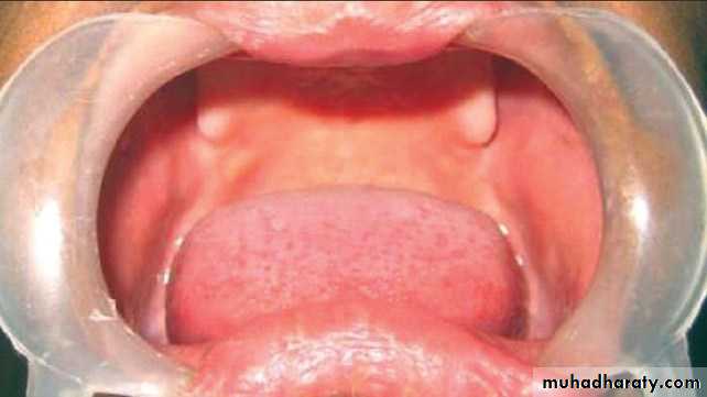 Development tooth disorders