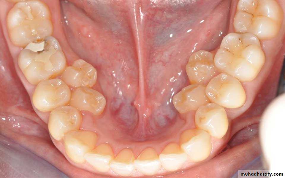 Development tooth disorders